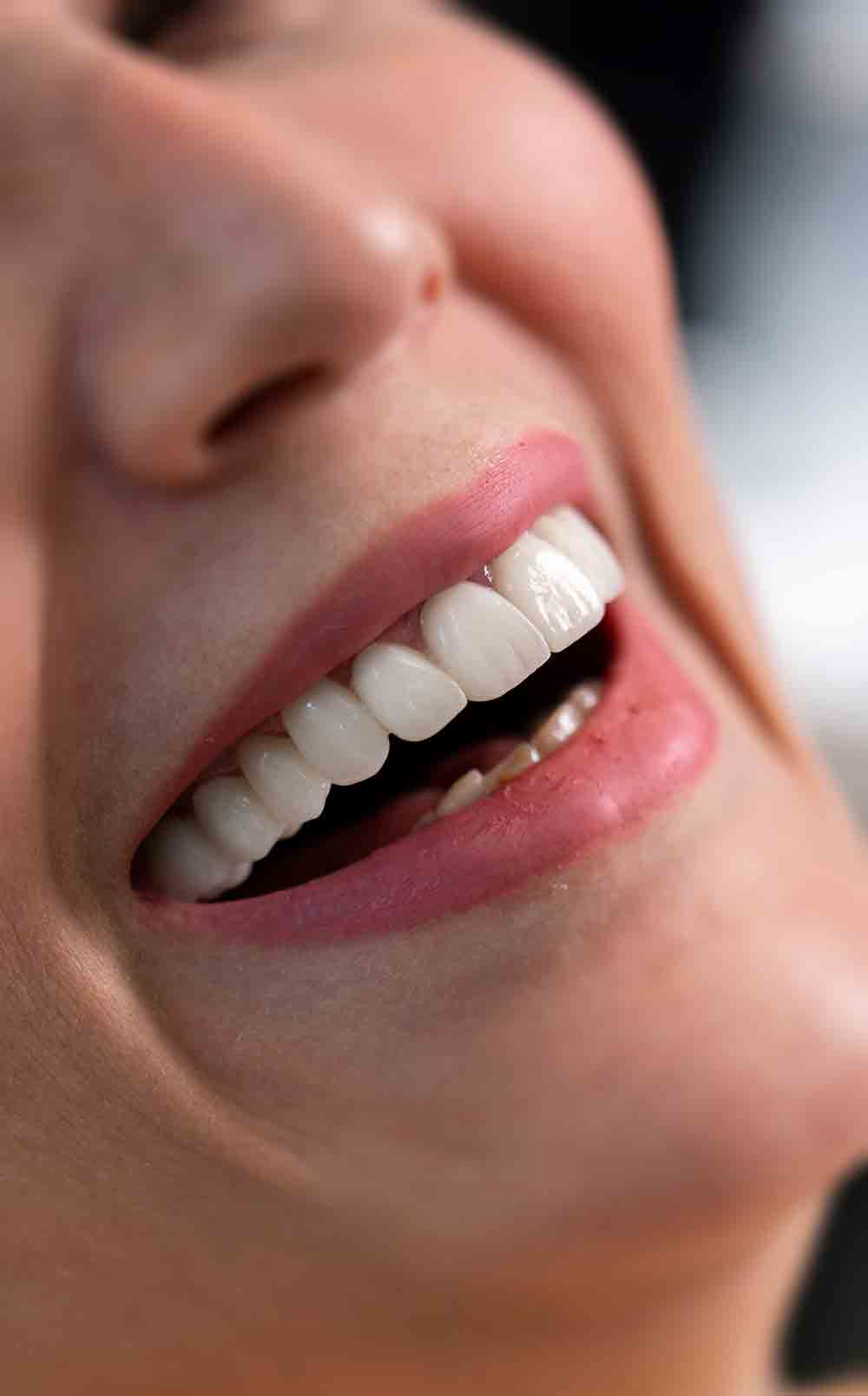 تصویری از فردی در حال خندیدن با دندان های ایمپلنت