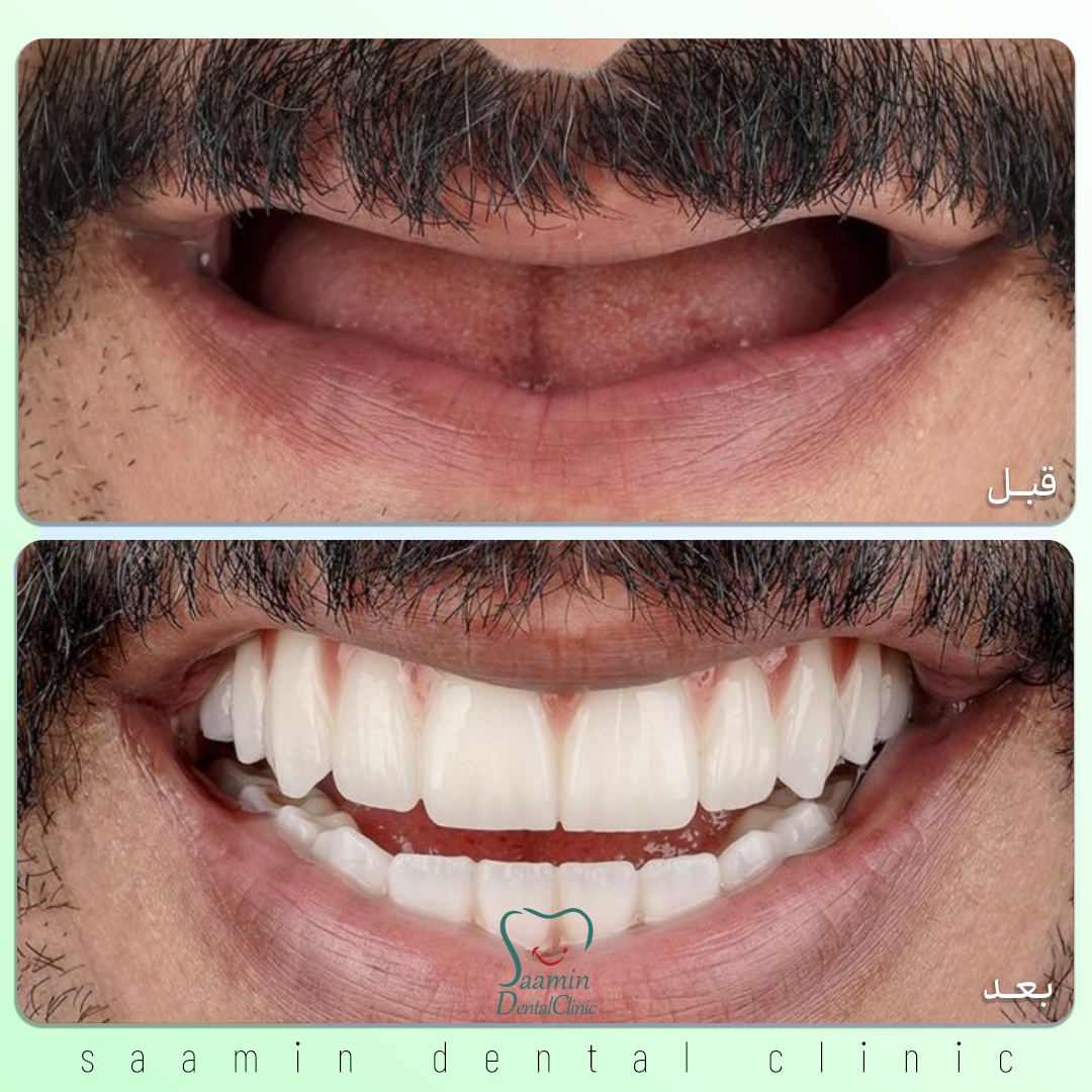 نمایی از ایمپلنت سالم در فک بیمار و نشان‌دهنده موفقیت مراقبت بعد از ایمپلنت زعفرانیه.