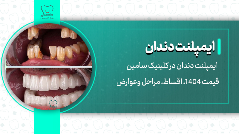 تصویر کاور خدمات ایمپلنت دندان در کلینیک دندانپزشکی سامین