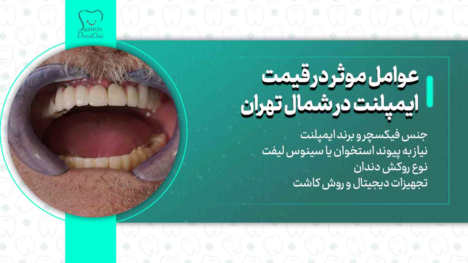 عوامل قیمت گذاری ایمپلنت