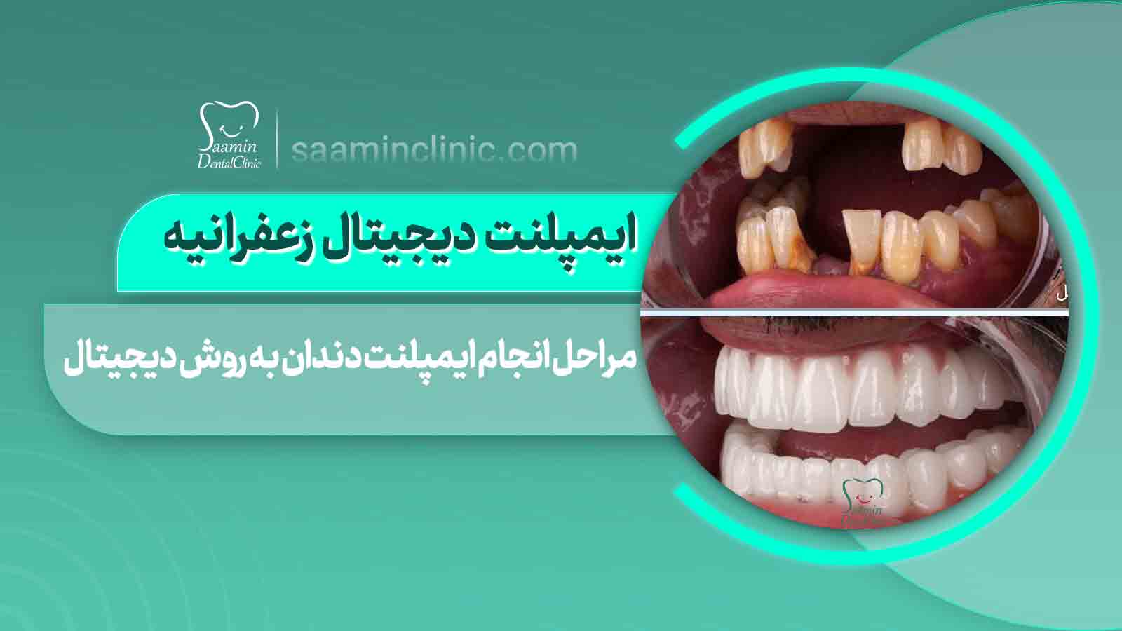 لبخند طبیعی یک بیمار پس از کاشت ایمپلنت دیجیتال، با تمرکز روی دندان‌های سالم و مرتب. ایمپلنت دیجیتال زعفرانیه؛ دقت میلی‌متری در لبخند شما