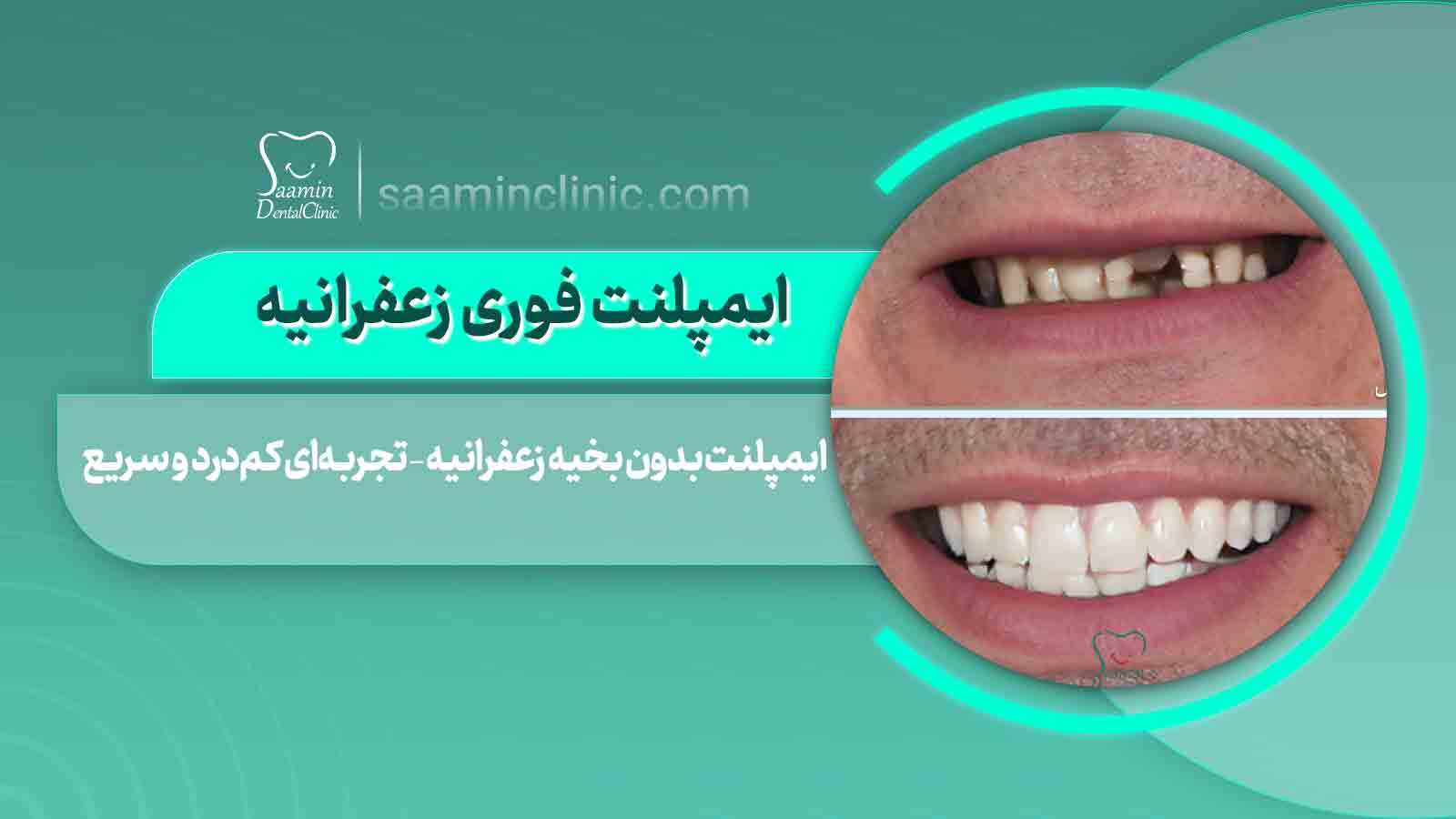 نمای نزدیک از دندان‌های سالم و فک بیمار قبل از ایمپلنت فوری زعفرانیه، آماده برای کاشت دندان.