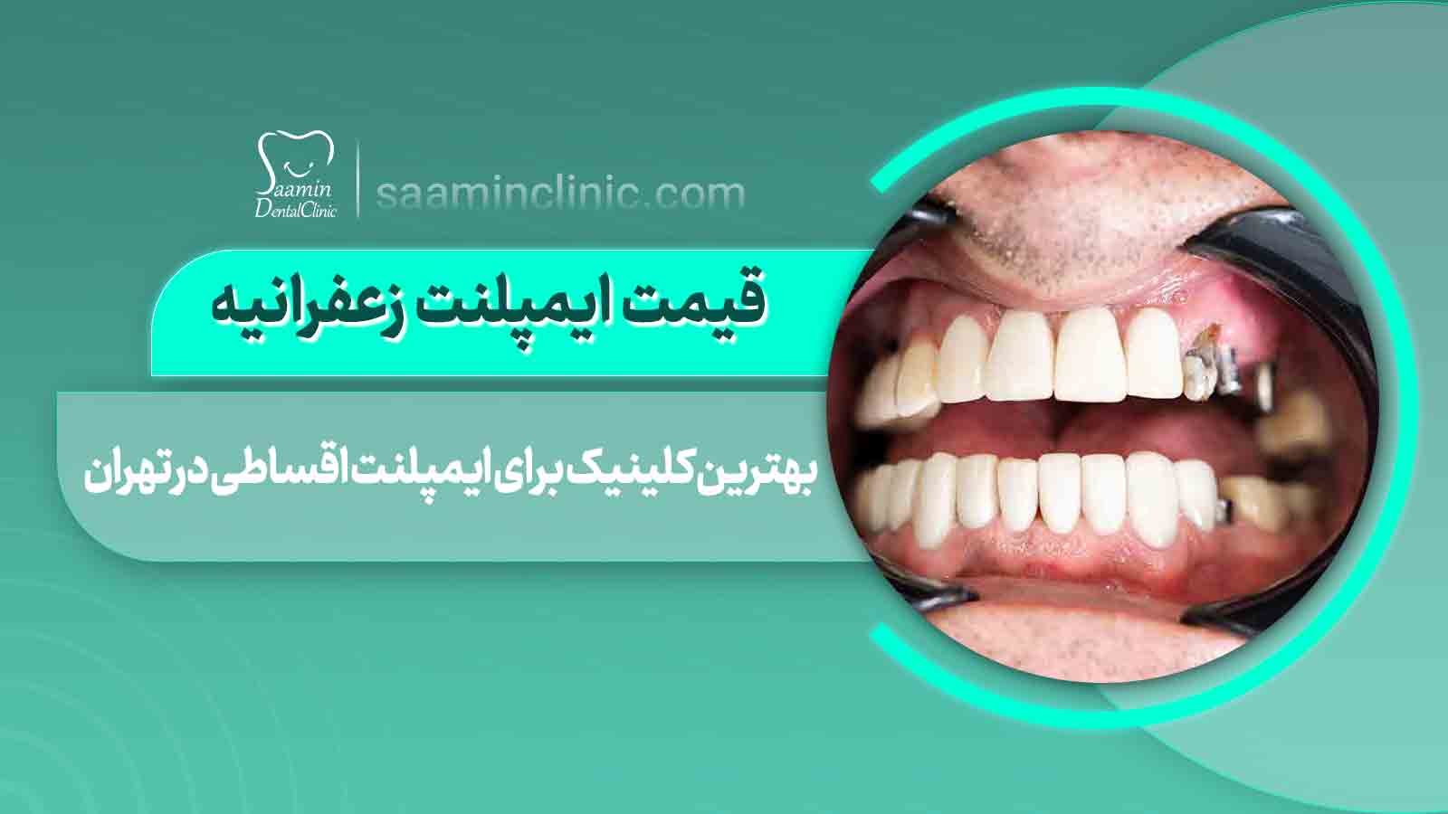 کیس ایمپلنت در کلینیک سامین در زعفرانیه