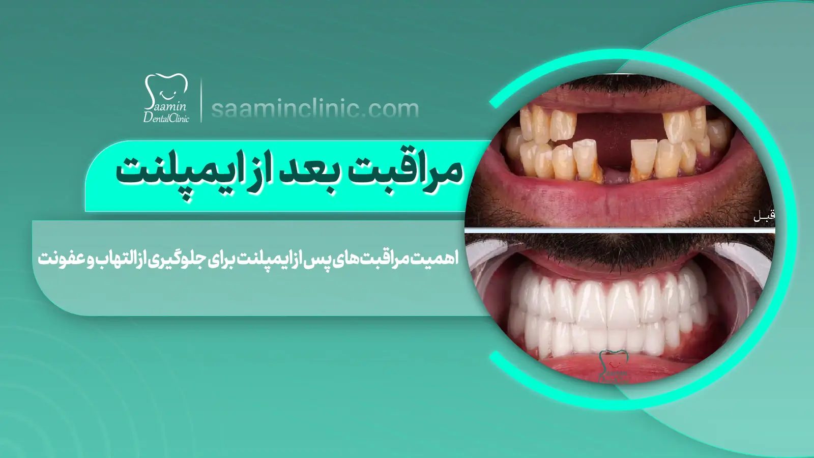 اهمیت مراقبت‌های پس از ایمپلنت برای جلوگیری از التهاب و عفونت