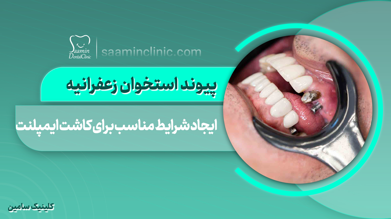 پیوند استخوان زعفرانیه