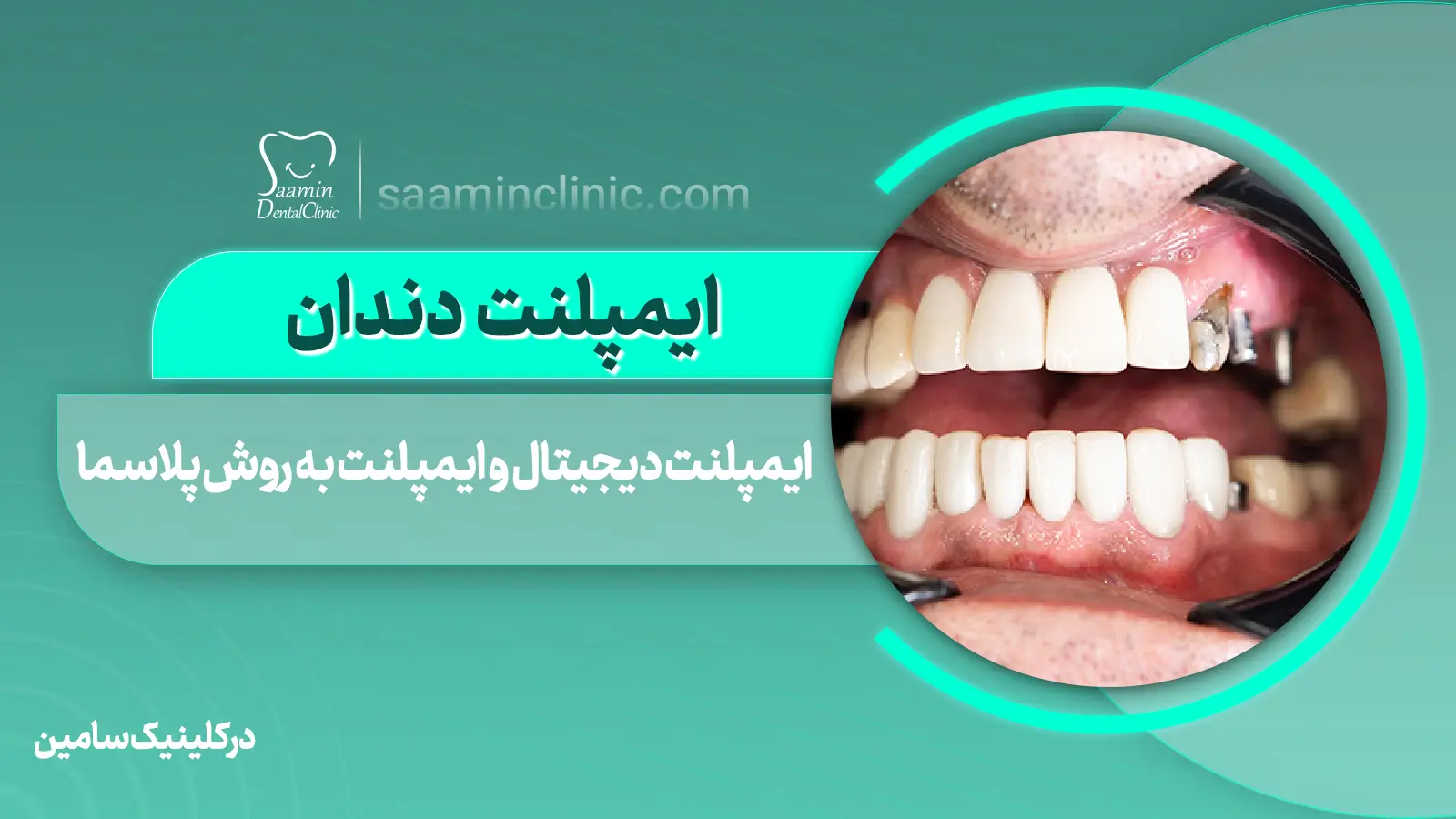 ایمپلنت دندان در کلینیک سامین