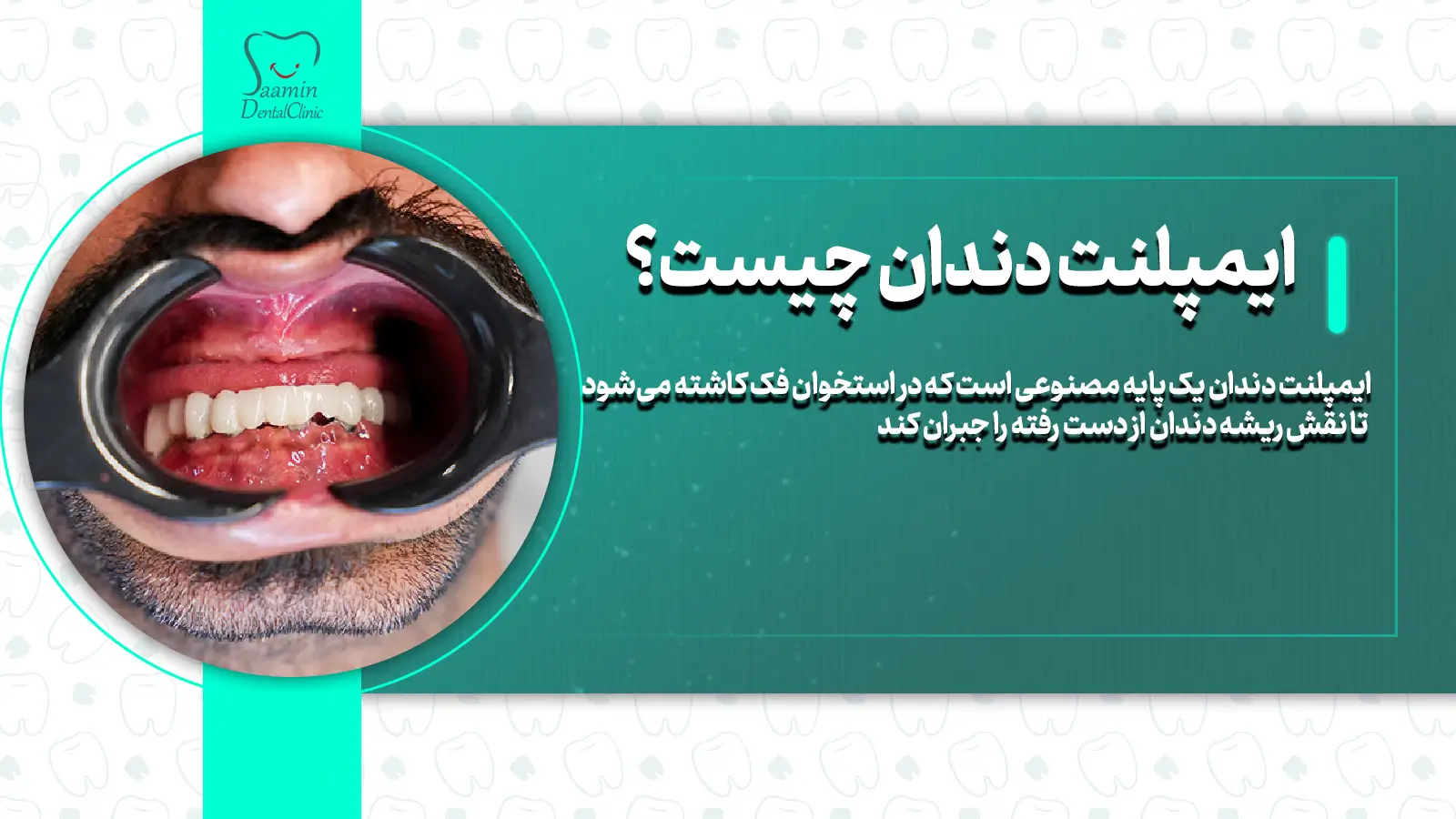 ایمپلنت دندان چیست؟ راهنمای کامل از تعریف تا مراحل و هزینه