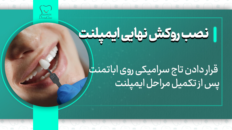 تصویری از نصب روکش نهایی ایمپلنت روی دندان یک بیمار در کلینیک سامین