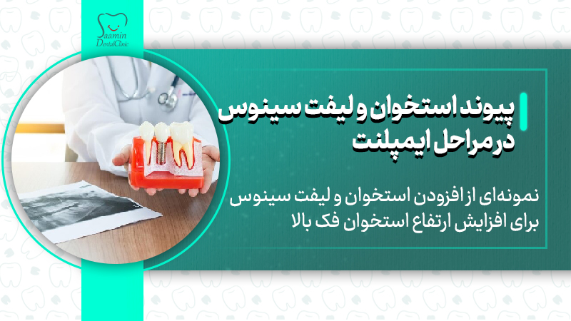 تصویری از بخشی از مرحله دوم ایمپلینت که پیوند استخوان و لیفت سینوس هست که نمونه ای به نمایش گذاشته شده است