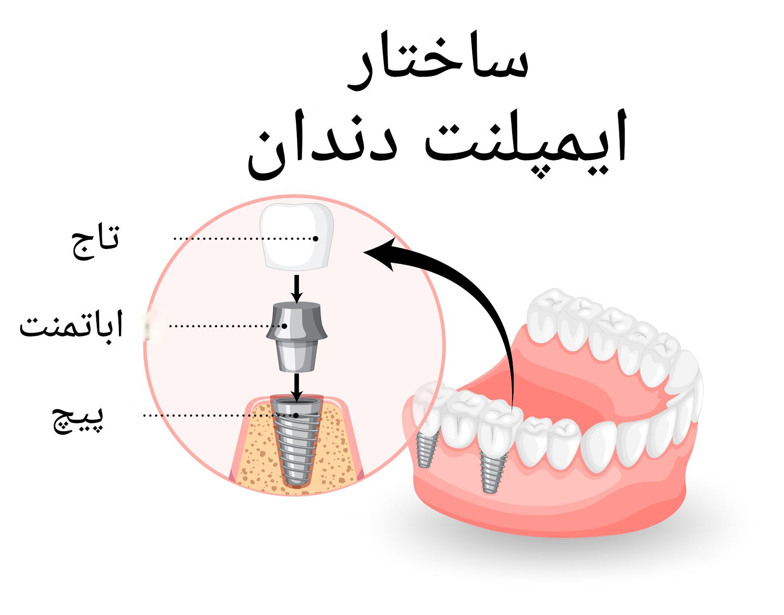ساختار ایمپلنت دندان