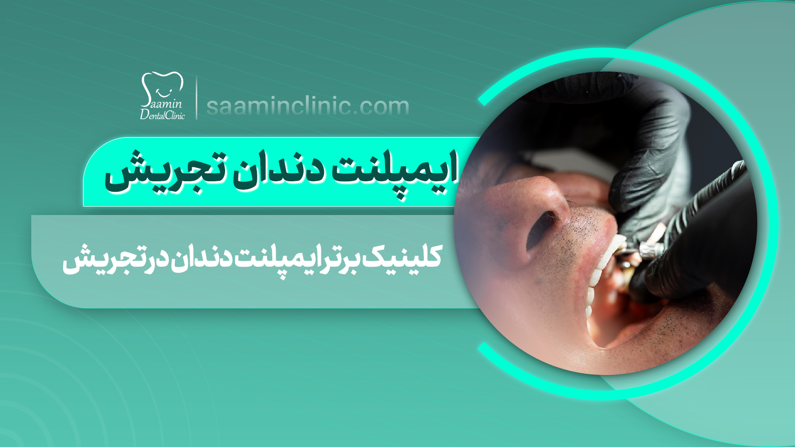کلینیک برتر ایمپلنت دندان در تجریش