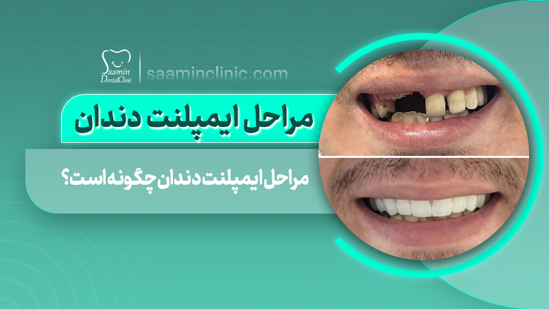 تصویر کاور مراحل ایمپلنت دندان در کلینیک سامین