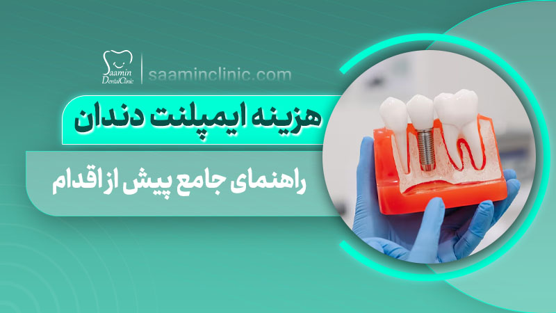 تصویری از کاور مقاله هزینه ایمپلنت دندان