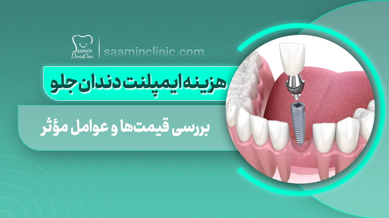 تصویر کاور مقاله هزینه ایمپلنت دندان جلو