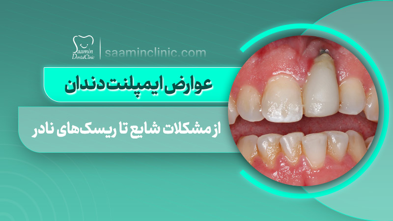 تصویری از کاور مقاله عوارض ایمپلنت دندان