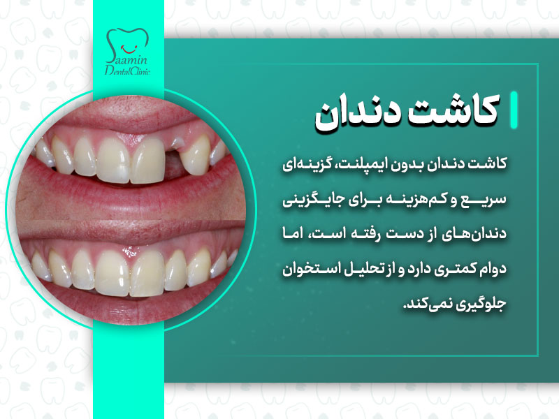 تصویری از دندان هایی کاشته شدن با متن کاشت دندان