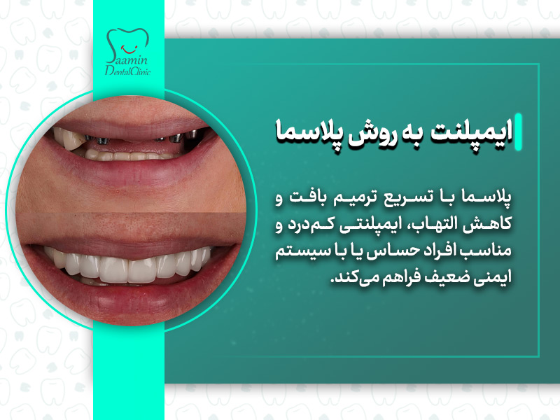 تصویری از نصب ایمپلنت دندان برای خانوم و توضیح ایمپلنت به روش پلاسما