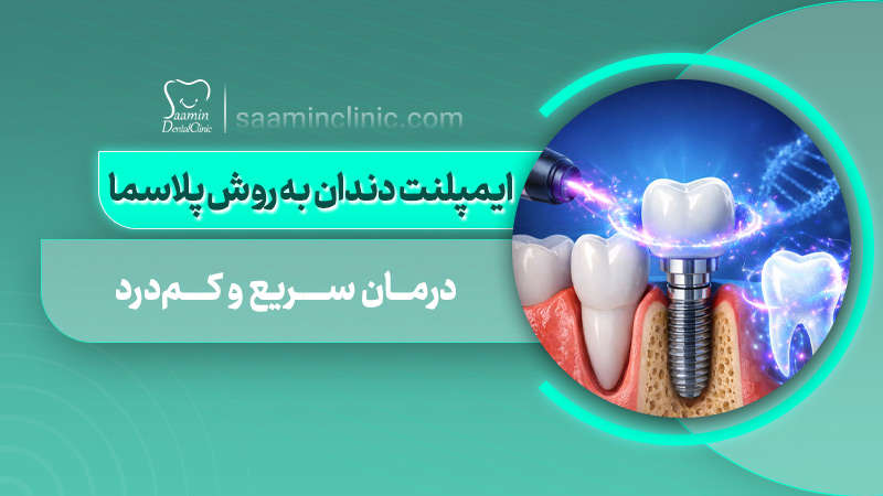 تصویری از کاور مقاله ایمپلنت دندان به روش پلاسما