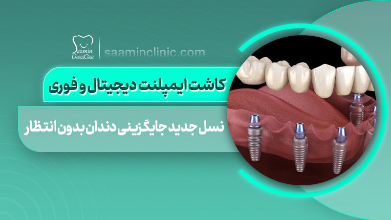 تصویر کاور مقاله کاشت ایمپلنت دیجیتال و فوری