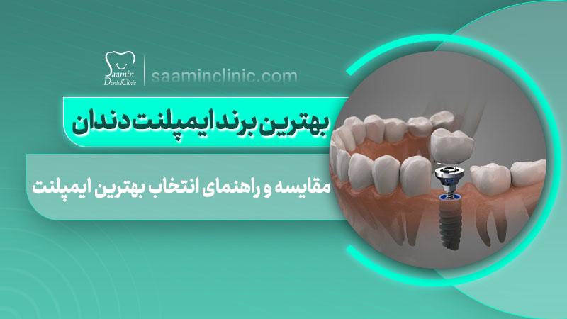 تصویری از کاور مقاله بهترین برند ایمپلنت دندان