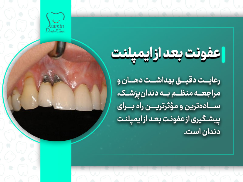 تصویری از دندان های عفونت شده و توضیح عفونت بعد از ایمپلنت