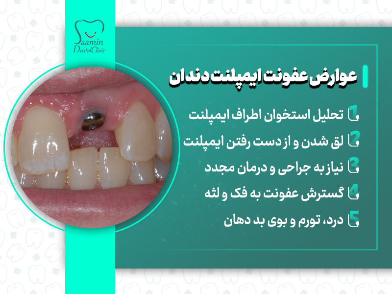 تصویری از نصب ایمپلنت دندان و توضیح عوارض عفونت ایمپلنت دندان
