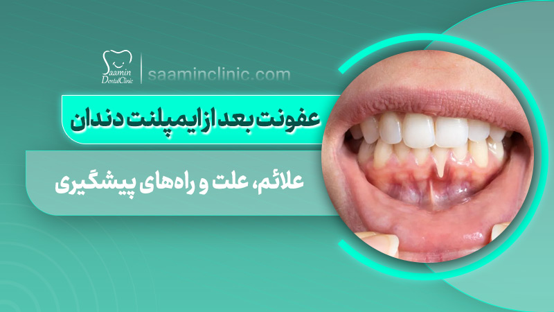 تصویری از کاور مقاله عفونت بعد از ایمپلنت دندان