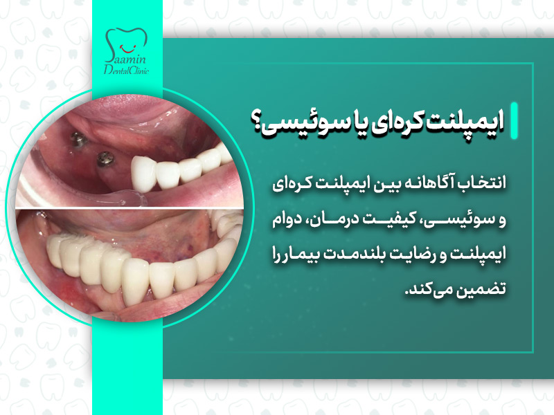 تصویری از ایمپلنت های دندان که در لثه فردی نمایش داده میشود همراه با توضیح ایمپلنت کرهای یا سوئیسی