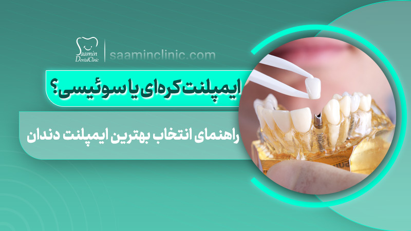 تصویر کاور مقاله ایمپلنت کره ای یا سوئیسی