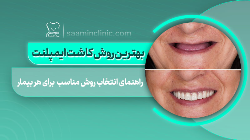 تصویر کاور مقاله بهترین روش کاشت ایمپلنت
