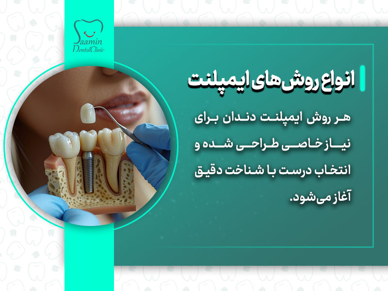 تصویری از یک قالب دندان در کنار صورت یک فرد و انواع روش های ایمپلنت‌ دندان
