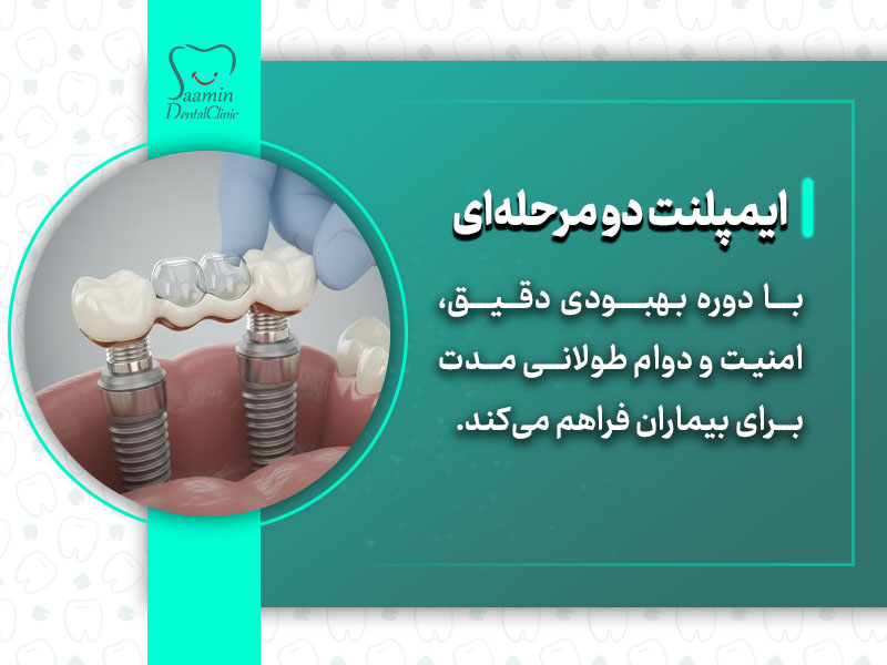 تصویری از یک دندان که نمونه ایمپلنت هست و ایمپلنت دو مرحله ای را نمایش میدهد
