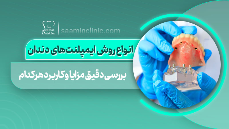 تصویر کاور مقاله روش های ایمپلنت‌ دندان