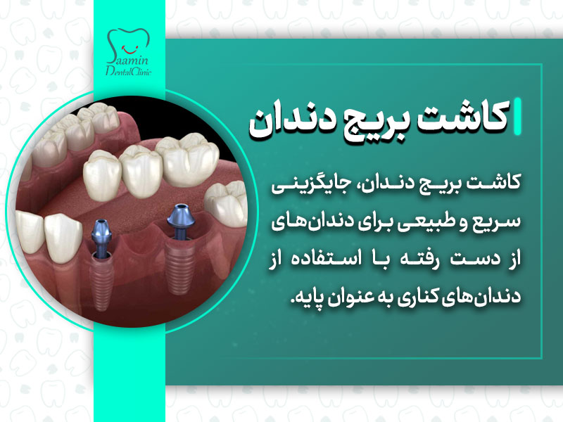 توضیح کاشت بریج دندان