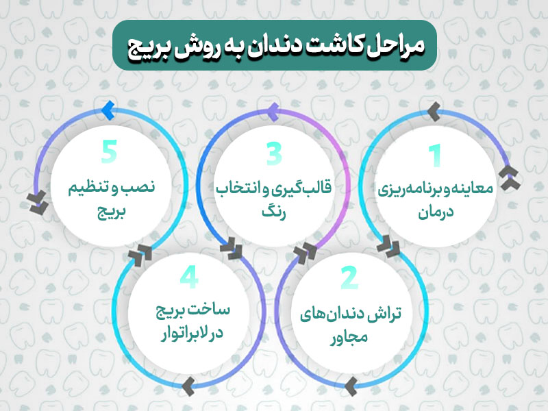 تصویری از مراحل کاشت دندان به روش بریج