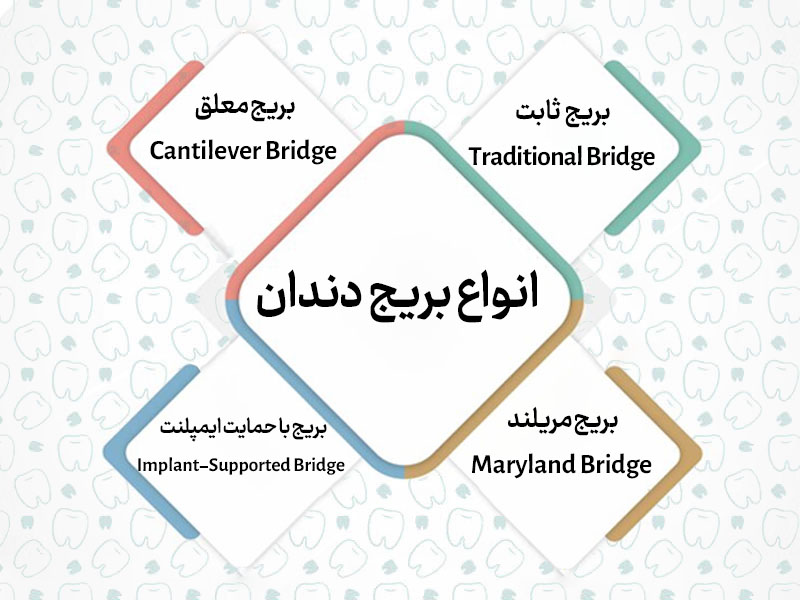تصویری از انواع بریج دندان به همراه متن انگلیسی
