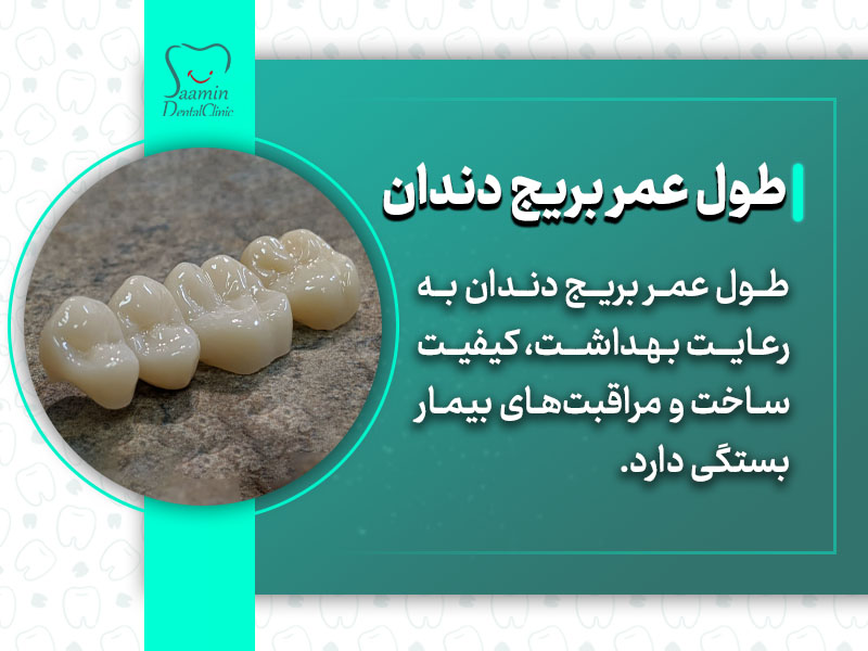 توضیح طول عمر بریج دندان