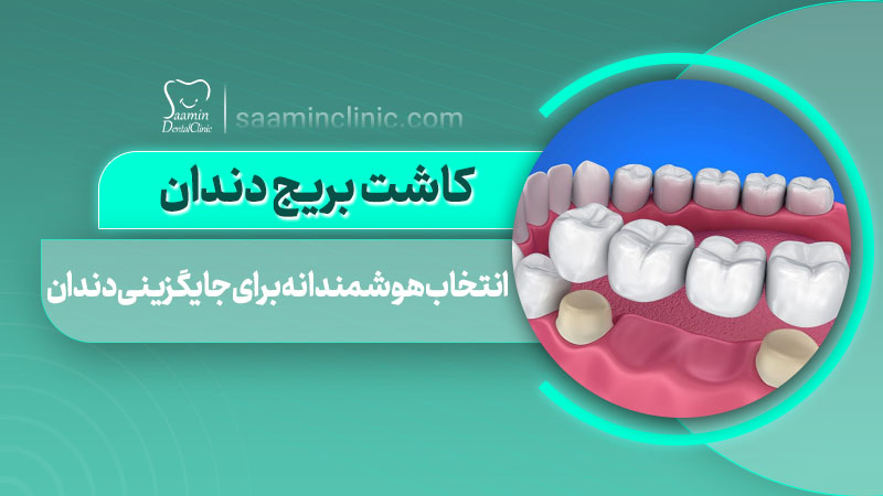 تصویر کاور مقاله کاشت بریج دندان