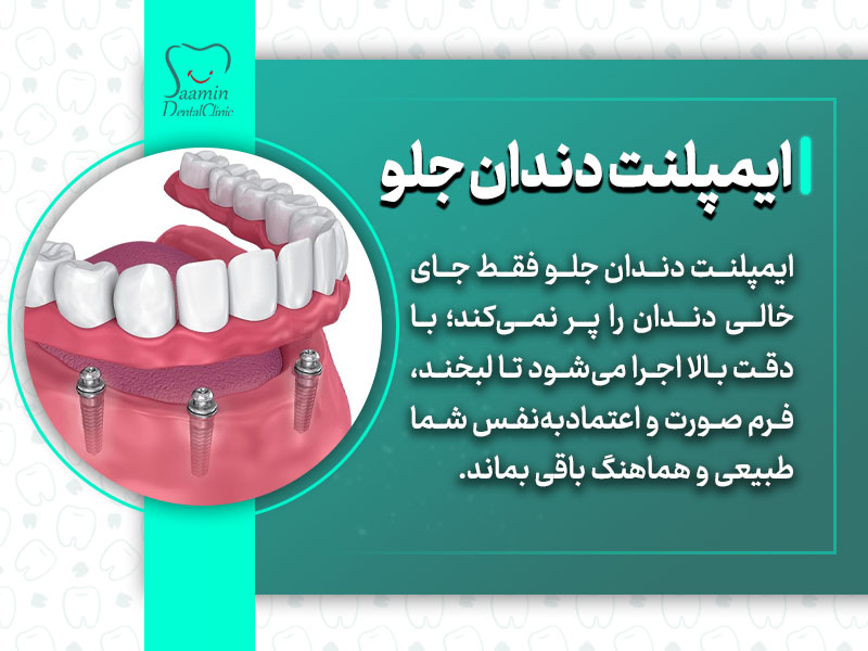 تصویر و توضیح ایمپلنت دندان جلو 