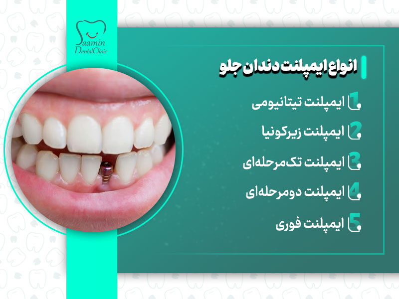 تصویری از توضیح انواع ایمپلنت دندان جلو