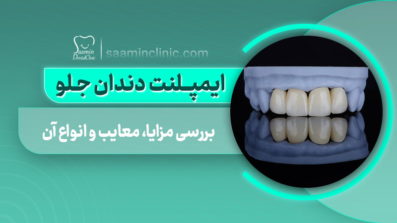 تصویر کاور مقاله ایمپلنت دندان جلو