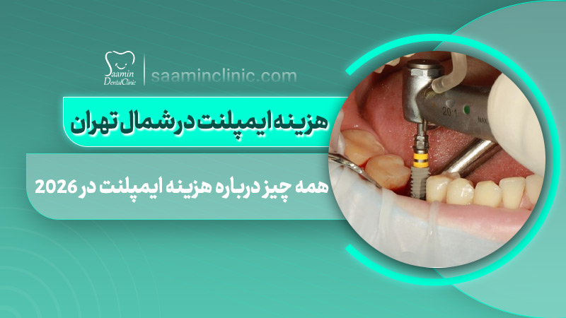 تصویری از کاور مقاله هزینه ایمپلنت در شمال تهران