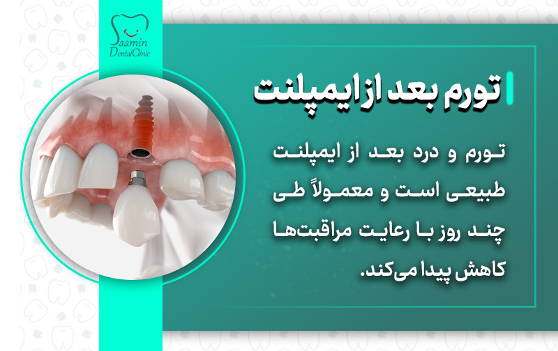 تصویری از قالب ایمپلنت کامپیوتری و توضیح تورم و درد بعد از ایمپلنت دندان