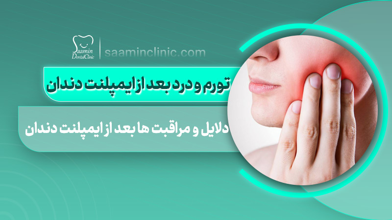 تصویری از کاور مقاله تورم و درد بعذ از ایمپلنت دندان