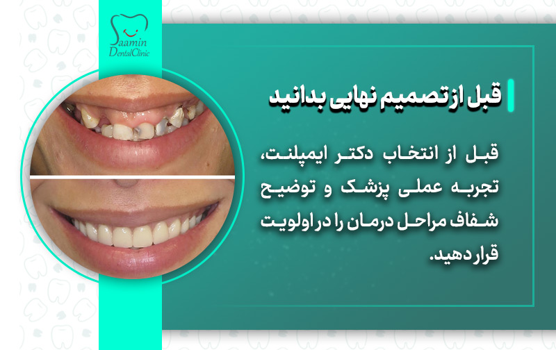 تصویری از قبل و بعد ایمپلنت دندان بیمار خانوم و توضیح معرفی بهترین دکتران ایمپلنت زعفرانیه