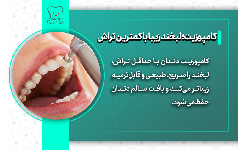تصویری از کامپوزیت دندان بیمار و توضیح کامپوزیت؛ لبخند زیبا با کمنرین تراش