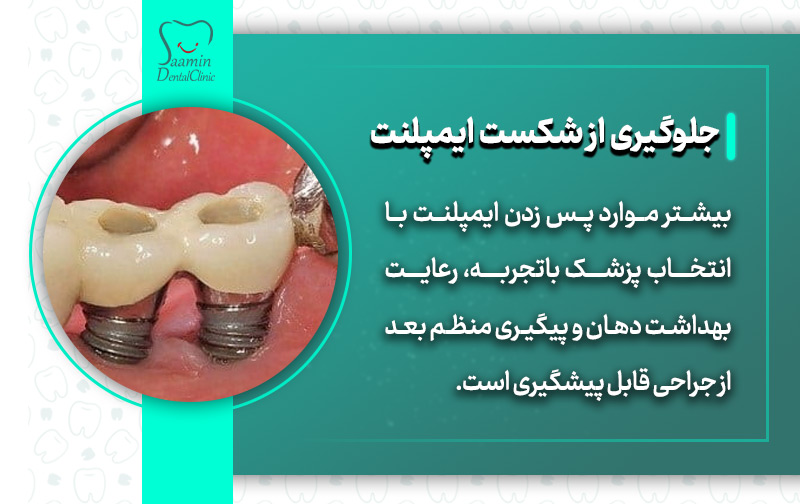تصویری از ایمپلنت شکسته شده و توضیح جلوگیری از شکست ایمپلنت دندان