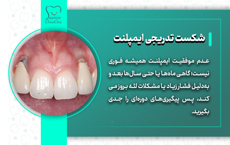 تصویری از ایمپلنت های شکسته شده و توضیح شکست تدریجی ایمپلنت