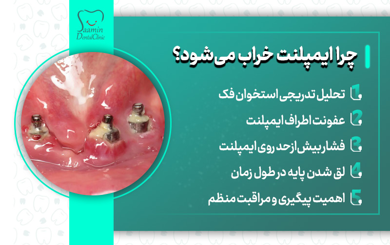 تصویری از ایمپلنت های خراب شده و توضیح چرا ایمپلنت خراب می شود