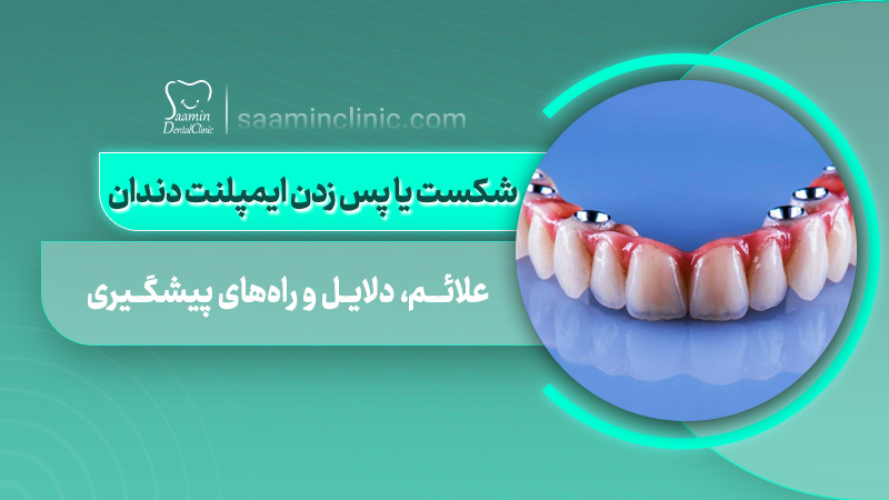 تصویری از کاور مقاله شکست یا پس زدن ایمپلنت دندان